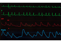 dpc fibrillation auriculaire